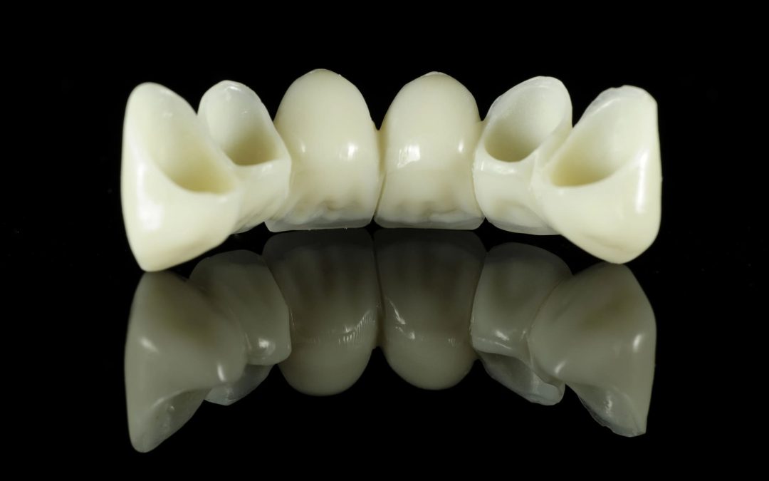 Teeth on One Dental Bridge: How Many?